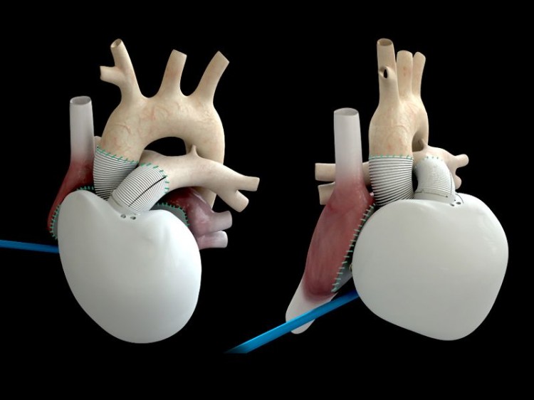 Coeur artificiel Carmat