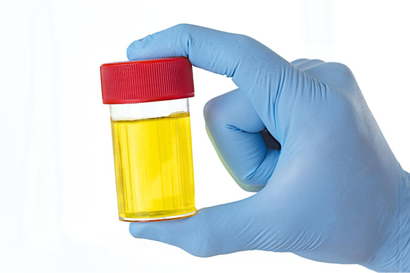 La couleur de votre urine un indicateur de votre santé